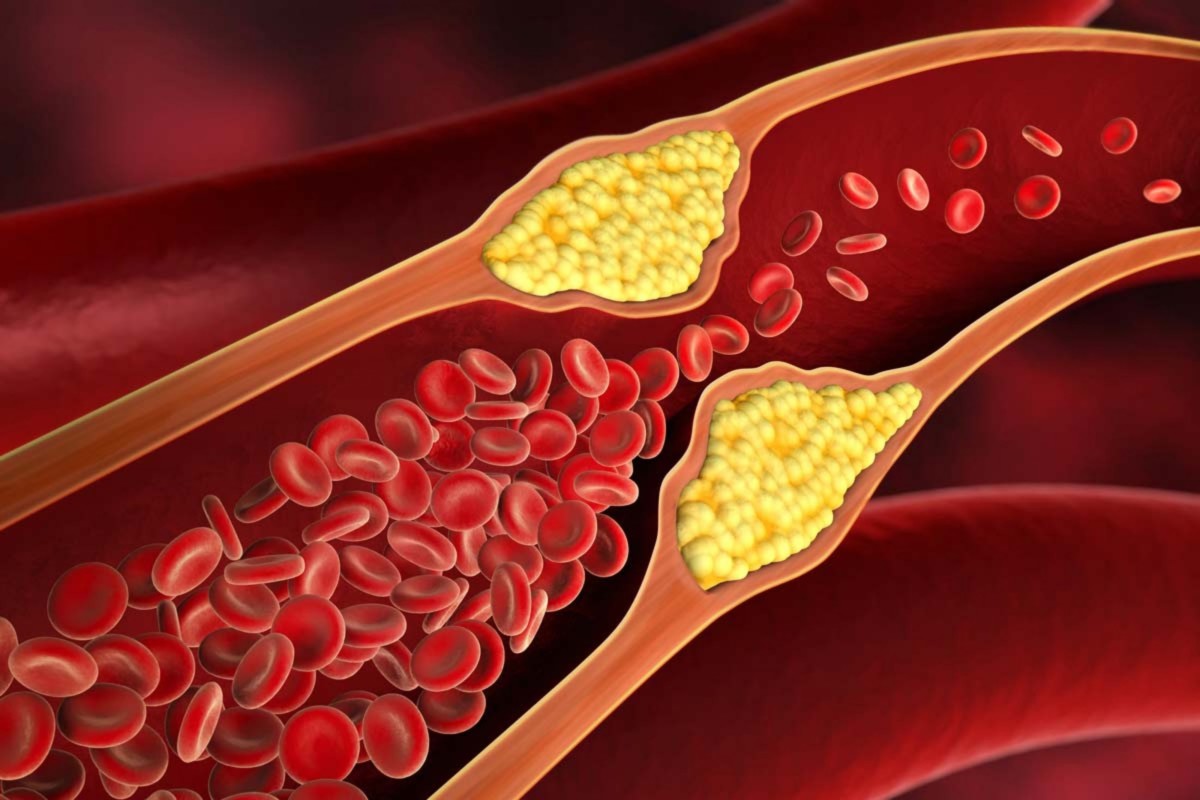 Очень неприятно и болезненно: врач назвала главный способ почистить сосуды  от холестерина