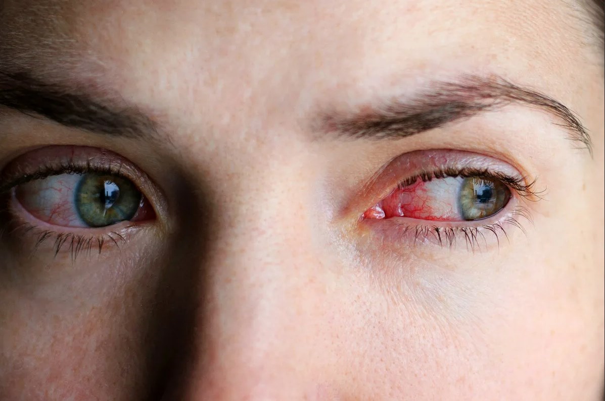 Классификация меланомы глаза