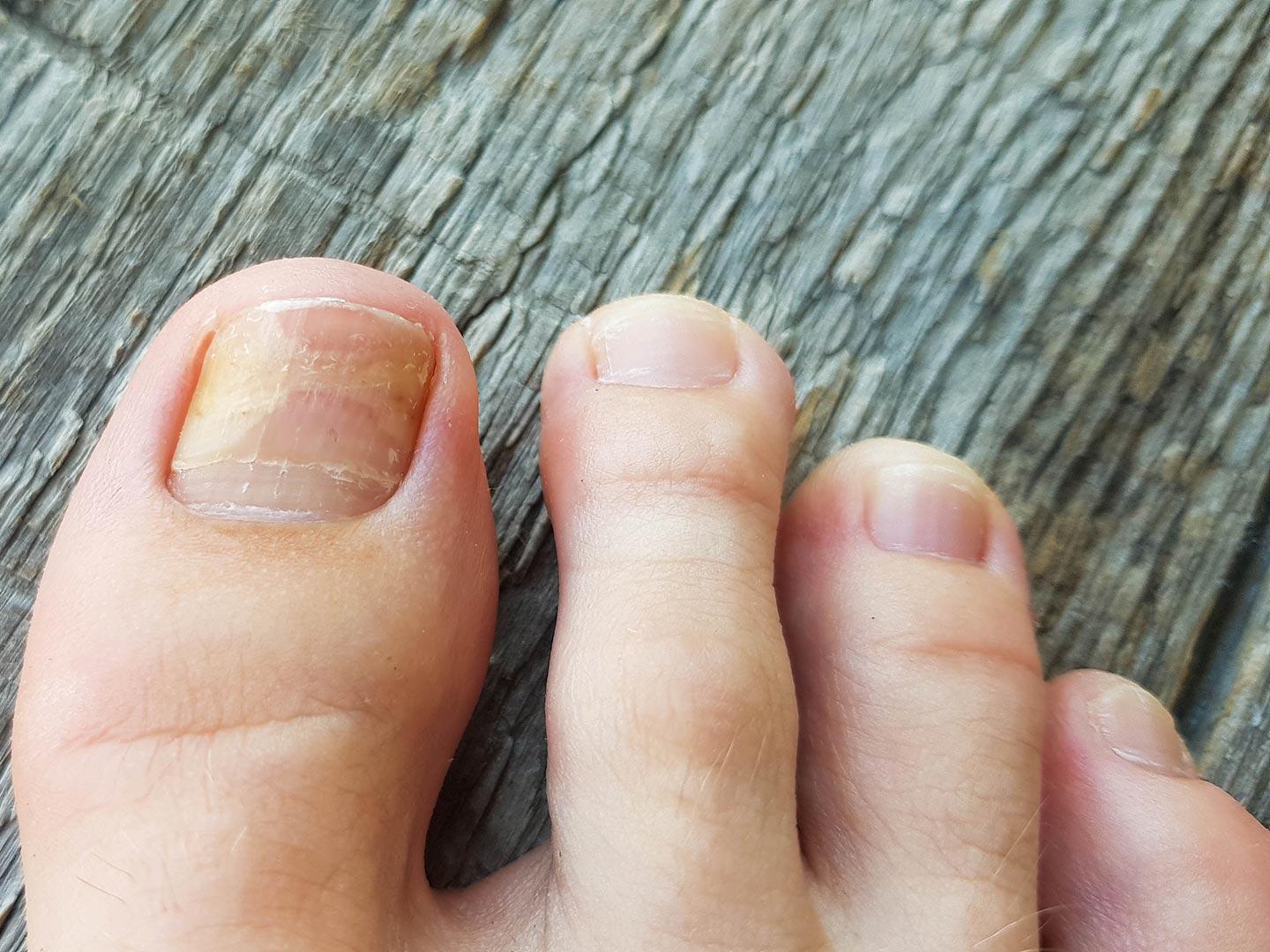Тяжелейшие осложнения: врач Мясников раскрыл опасность лечения грибка  ногтей народными методами