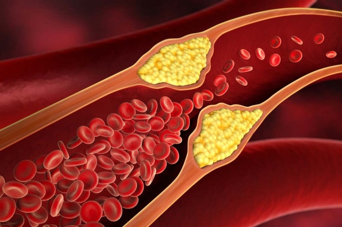 Очень неприятно и болезненно: врач назвала главный способ почистить сосуды от холестерина