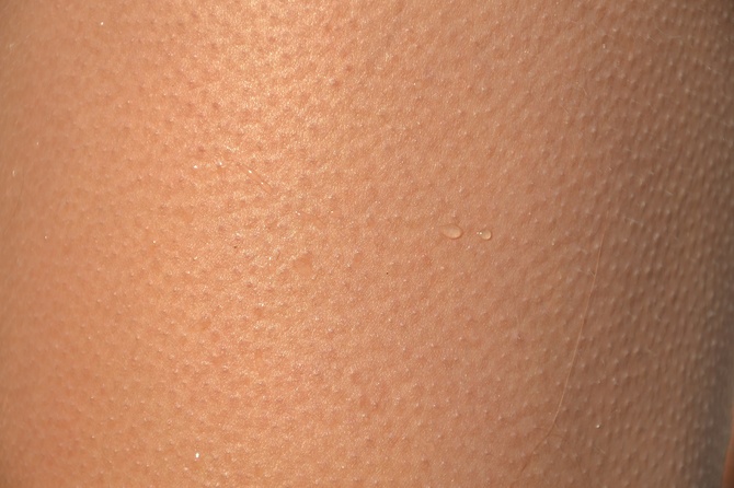 Больные страдают из-за внешнего вида: названы главные способы борьбы с отталкивающей гусиной кожей