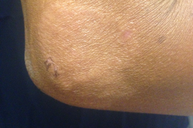 В Румынии и Хорватии впервые за несколько десятков лет выявлены случаи проказы