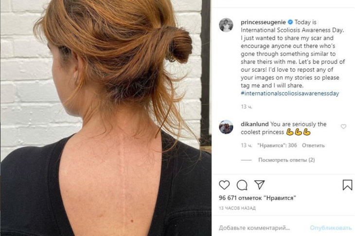 «Горжусь!»: принцесса Евгения похвасталась шрамом