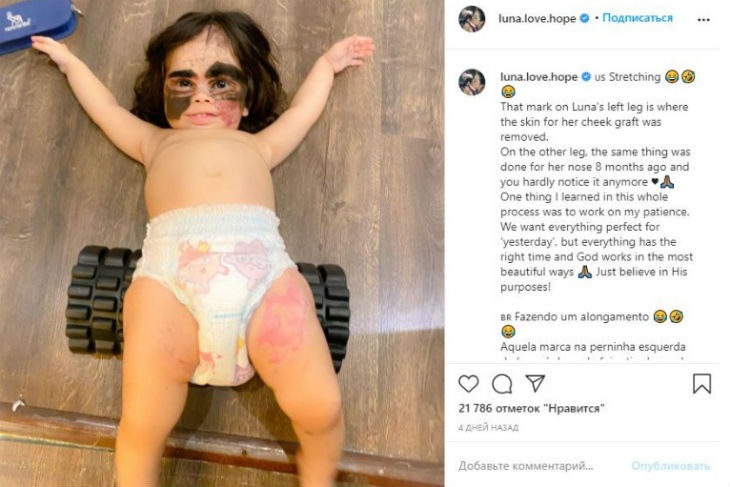 Мама девочки с «маской Бэтмена» показала результаты очередной операции