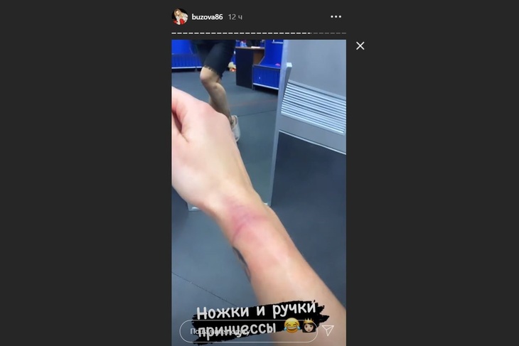 Бузова показала страшные последствия участия в «Ледниковом периоде»