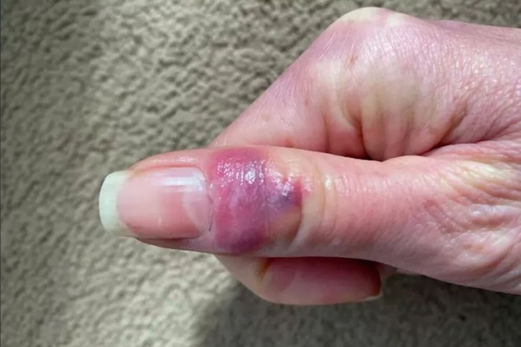 Опубликованы фото нетипичного симптома нового коронавируса