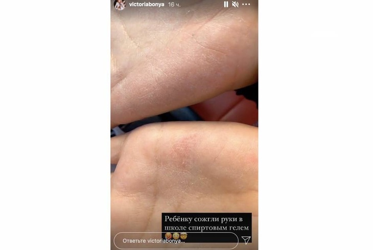 «Ребенку сожгли руки в школе»: Боня пожаловалась на проблемы дочери «Ребенку сожгли руки в школе»: Боня пожаловалась на проблемы дочери