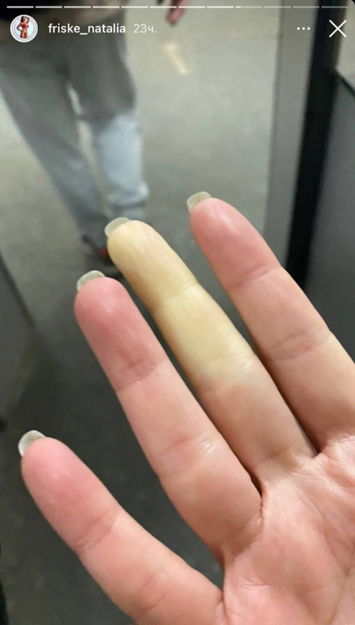 «Печально»: сестра Фриске рассказала о серьезных проблемах со здоровьем