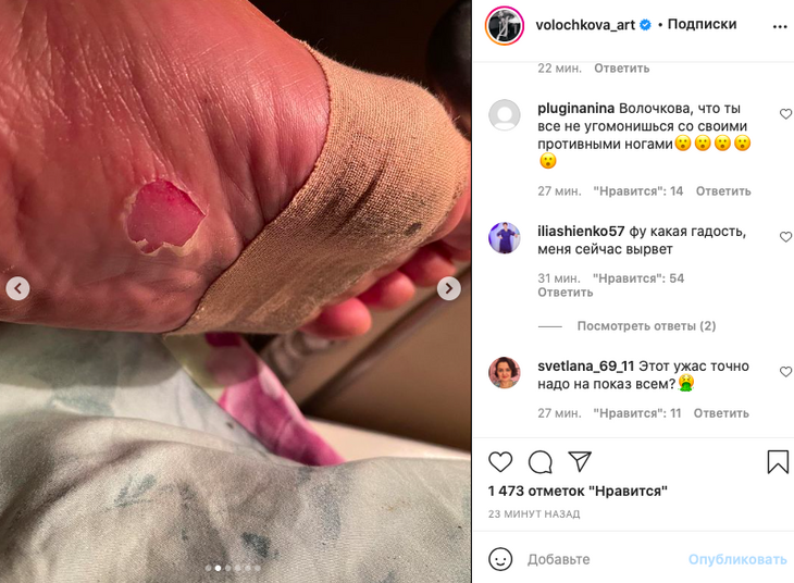 «Фу, какая гадость»: Волочкова разозлила поклонников снимком обезображенных ног