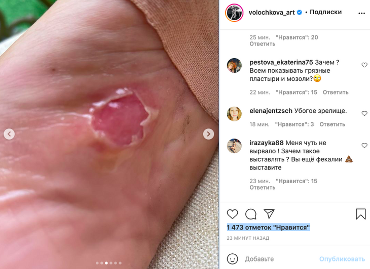 «Фу, какая гадость»: Волочкова разозлила поклонников снимком обезображенных ног