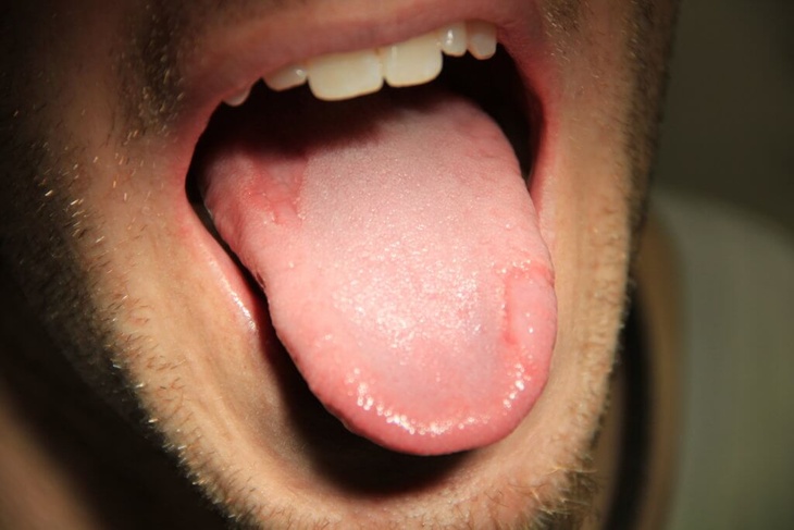 Ожоги слизистой полости рта - лечение термических ожогов языка, полости рта