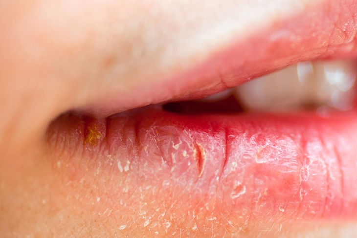 Говорит о смертельной болезни: врач назвала главную опасность трещин в уголках губ