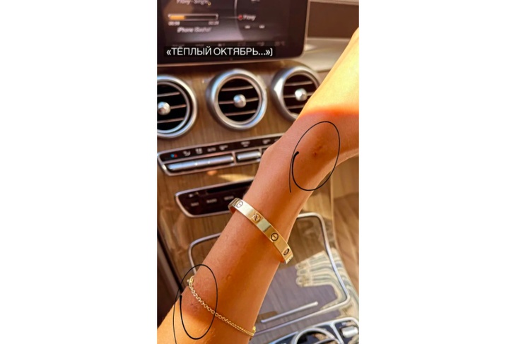 Саша Дони пожаловалась, что подарок Тимати оставил шрамы на ее руке