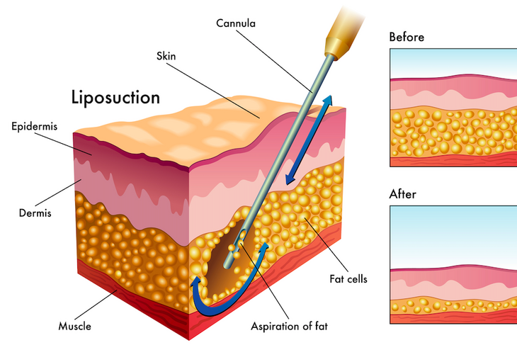 Пластический хирург объяснил, почему липосакция не поможет похудеть