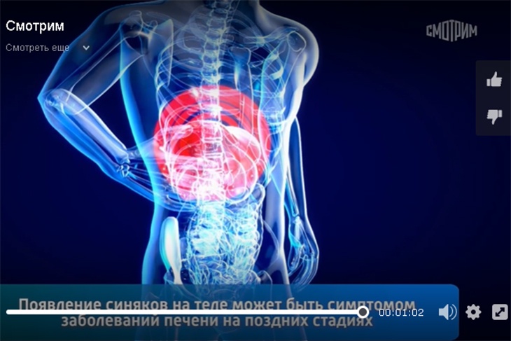 «Это не просто заболевание, это уже недостаточность»: Мясников рассказал о связи синяков с печенью