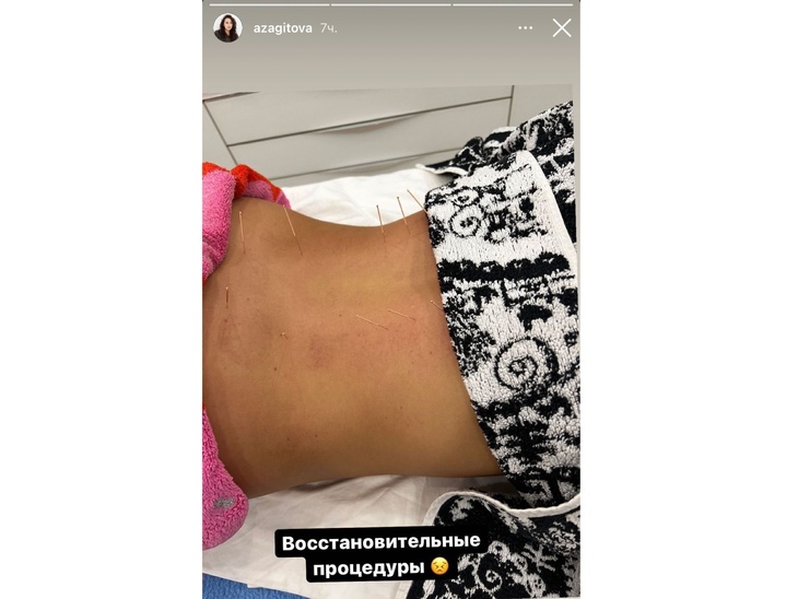 Обессиленная Загитова показала свое тело, все проколотое иголками: фото