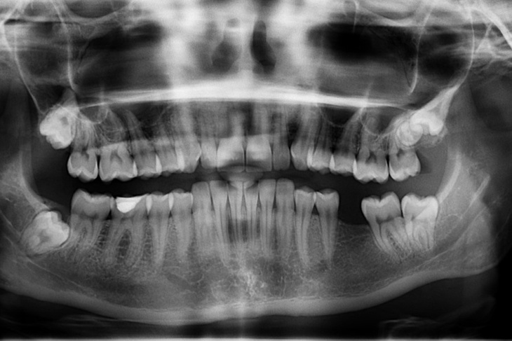 Глухота и боли: почему отсутствие хотя бы одного зуба может привести к страшным последствиям