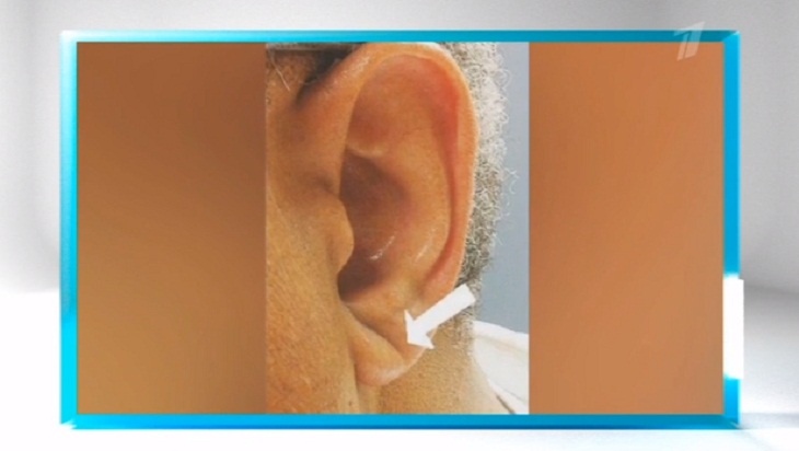 Срочно к зеркалу: Малышева объяснила, о какой серьезной болезни говорит полоска на мочке уха