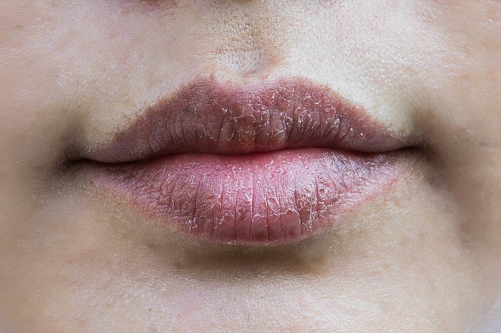 Признаки серьезного заболевания: врач Мясников раскрыл опасные причины сухости губ