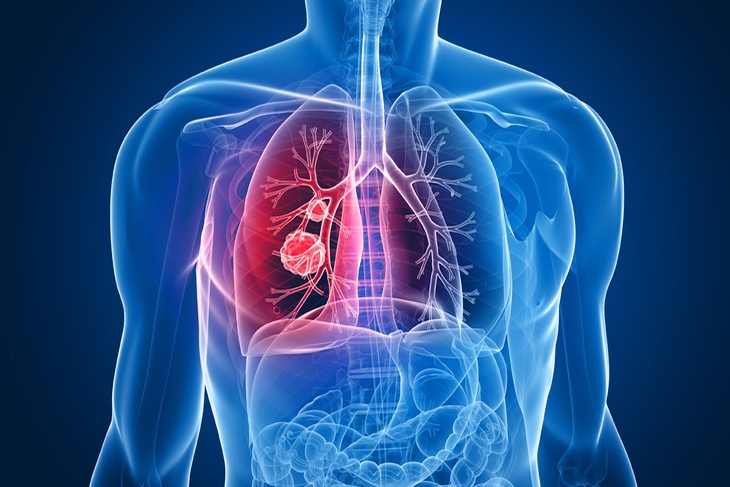 Дышать становится невыносимо: описаны симптомы поражения организма раком легких
