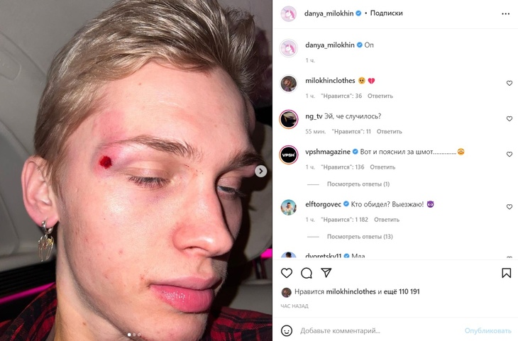 «Тебя избили?»: Милохин шокировал фанатов окровавленным лицом