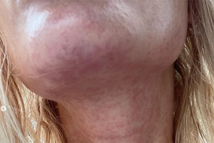 Шея и лицо в жутких пятнах: у Рудовой случилась аллергия на мадагаскарских тараканов и личинок