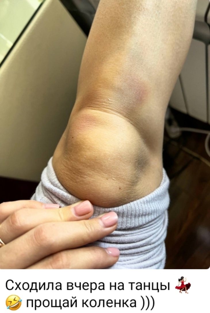 Российская синхронистка показала синяки на колене после похода на танцы