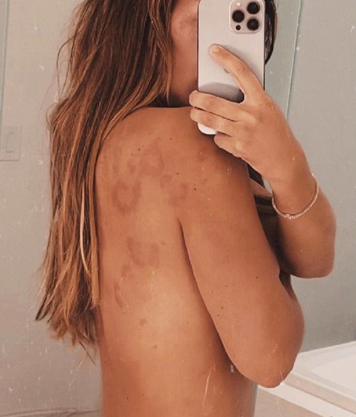 «Научусь с этим жить, не ненавидя мое тело»: Седокова показала усыпанную из-за болезни пятнами спину