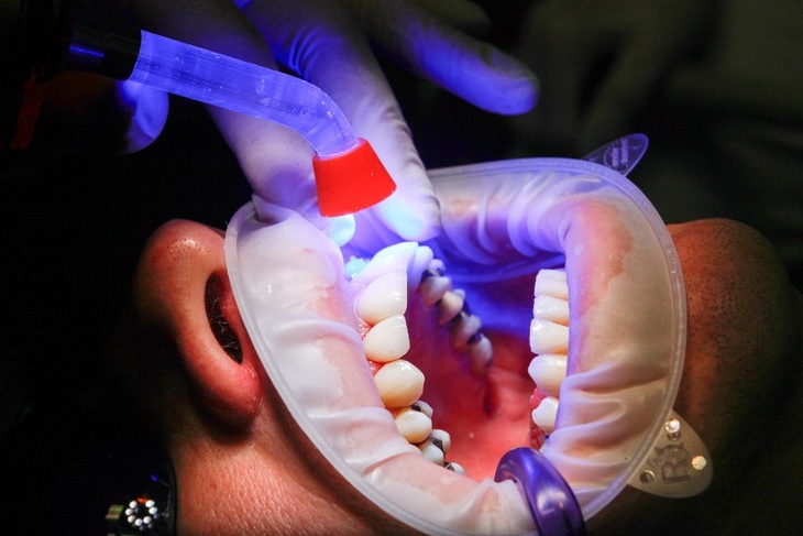 Дырка в каждом зубе: какие продукты убивают эмаль