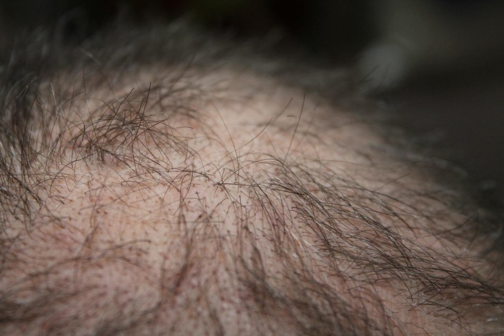 Эндокринолог объяснила, почему мужчины лысеют после коронавируса