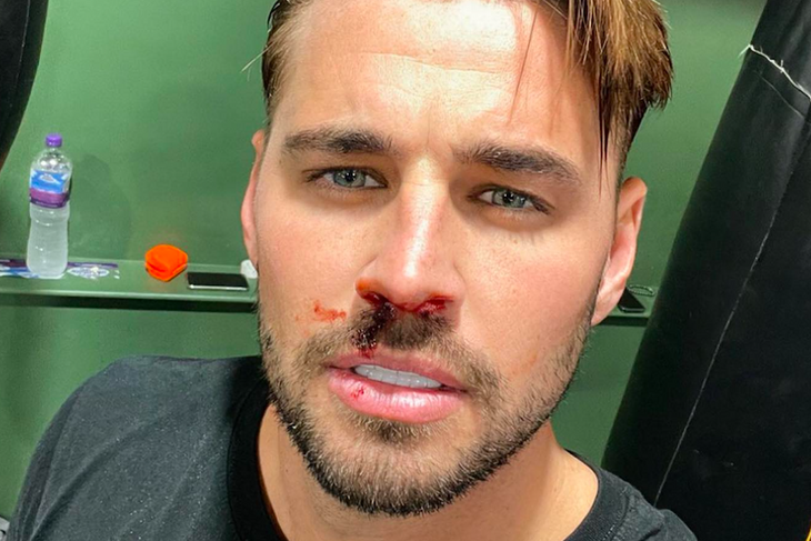 Carl Woods had his nose smashed to a bloody pulp