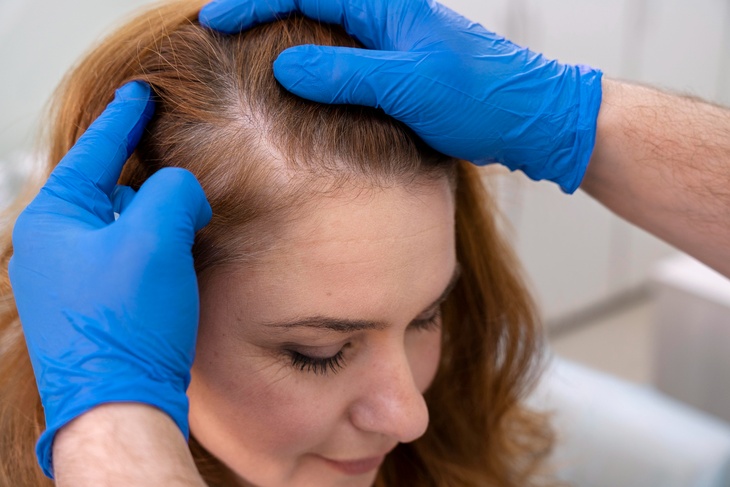 Риск полного облысения: врач назвала внезапные причины выпадения волос у женщин