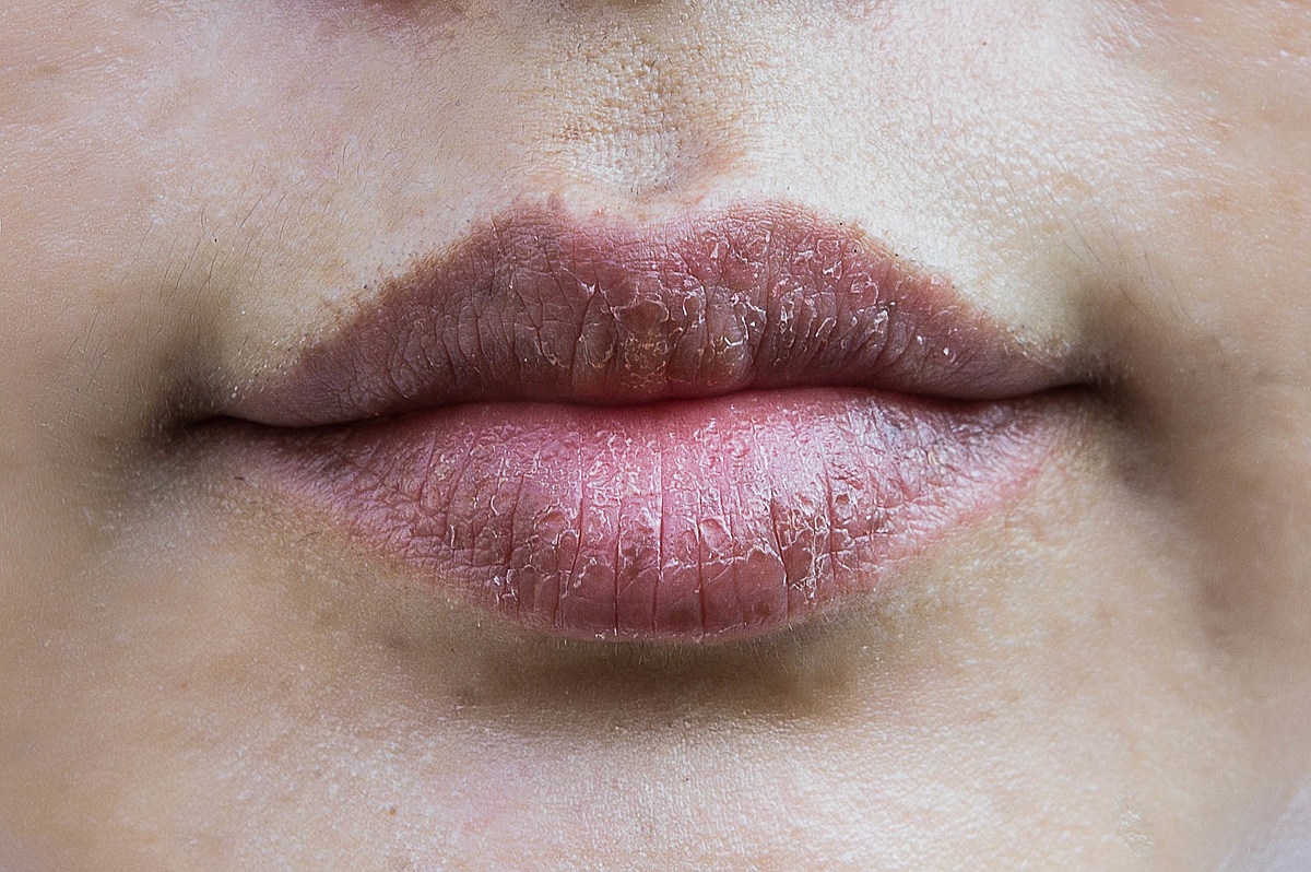 Почему у взрослых трескаются губы: причины и способы решения проблемы
